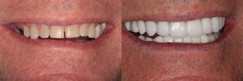 Full Mouth Makeover: Patient 5