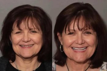 Full Mouth Makeover: Patient 4