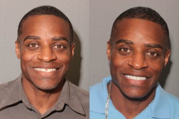 Porcelain Veneers: Patient 2