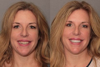 Porcelain Veneers: Patient 4