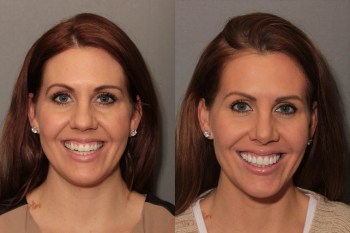 Porcelain Veneers: Patient 7