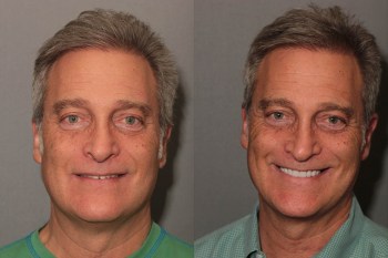 Porcelain Veneers: Patient 10