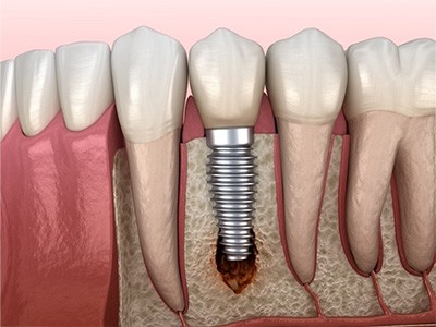 Dental Implants Restoration Huntersville