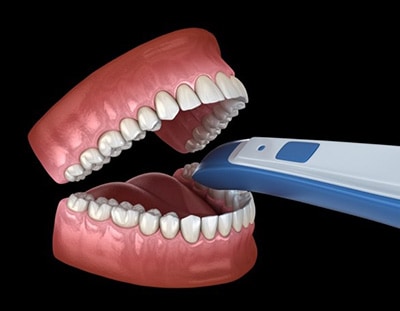 Intraoral Scanner Huntersville