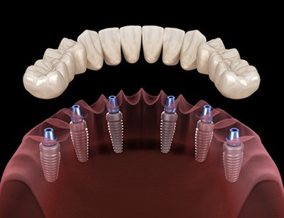 Dentures With Implants Huntersville
