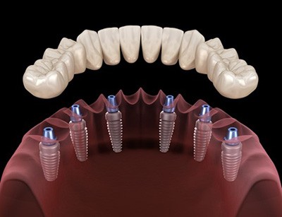 Dentures With Implants Huntersville