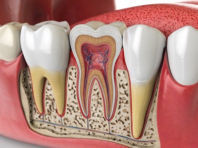 Root Canal Huntersville