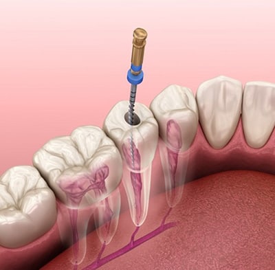 Root Canal Treatment Huntersville 