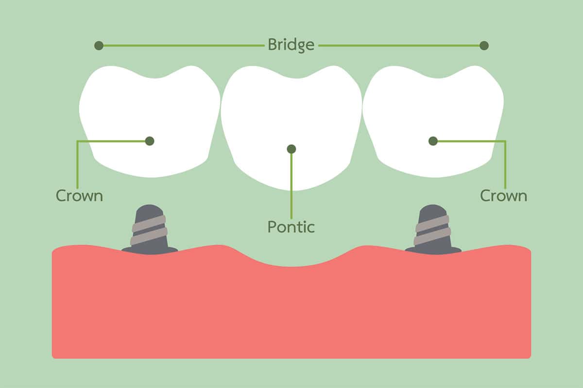Benefits of dental bridges