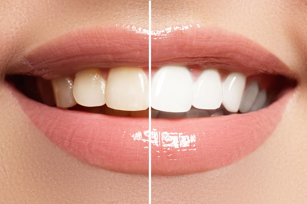 Teeth Whitening in Huntersville