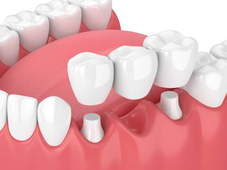 3d-render-of-jaw-with-dental-bridge-941012812_5000x3750-768x576 Dental Bridges in Charlotte & Huntersville, NC