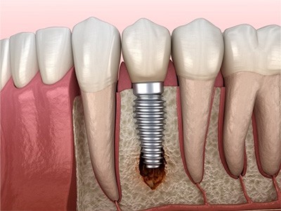 dental-implants-1 Dental Implant Restoration in Charlotte & Huntersville, NC