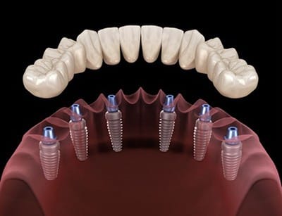implant-supported-dentures-2 Implant-Supported Dentures in Charlotte & Huntersville, NC