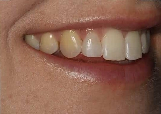 After Image: Dental Bonding - right-front-oblique