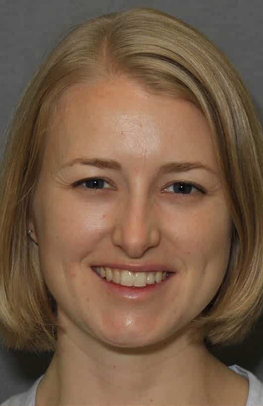 Before Image: Dental Bonding - front