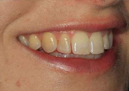 Before Image: Dental Bonding - right-front-oblique