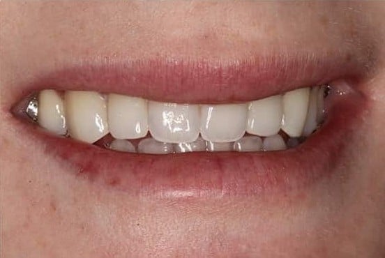 After Image: Dental Bonding - front