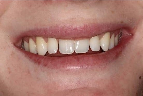 Before Image: Dental Bonding - front