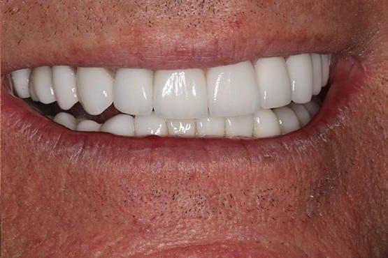 After Image: Full Mouth Makeover - front