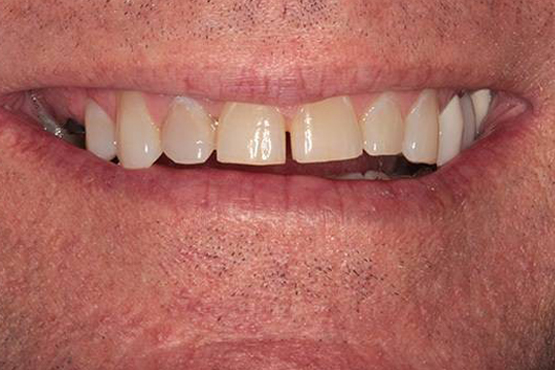 Before Image: Full Mouth Makeover - front