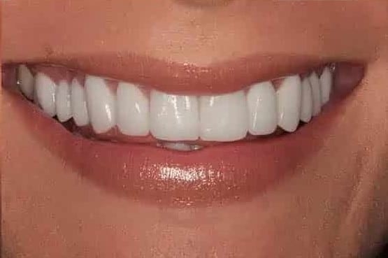 After Image: Full Mouth Makeover - front