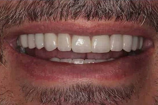 After Image: Full Mouth Makeover - front