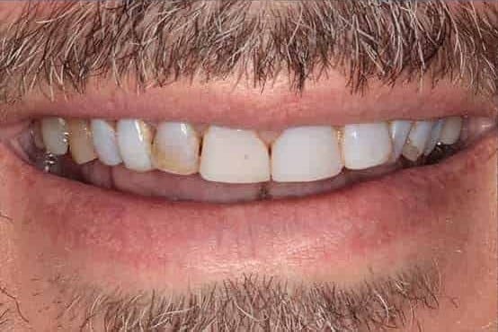 Before Image: Full Mouth Makeover - front