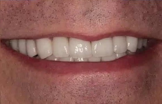 After Image: Full Mouth Makeover - front