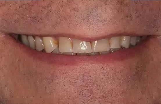 Before Image: Full Mouth Makeover - front