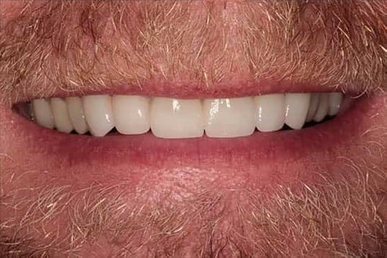 After Image: Implants & Crowns - front