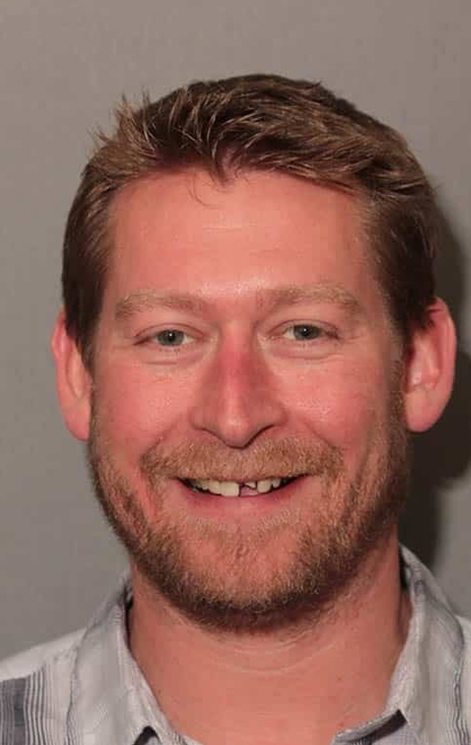 Before Image: Implants & Crowns - front