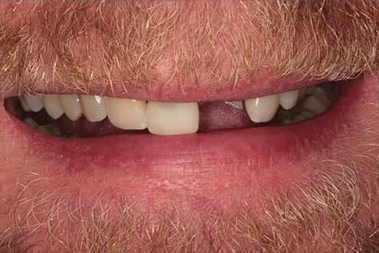 Before Image: Implants & Crowns - front