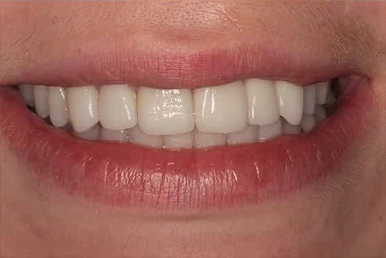 After Image: Porcelain Bridges - front