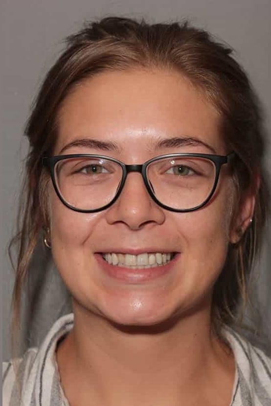 Before Image: Porcelain Bridges - front