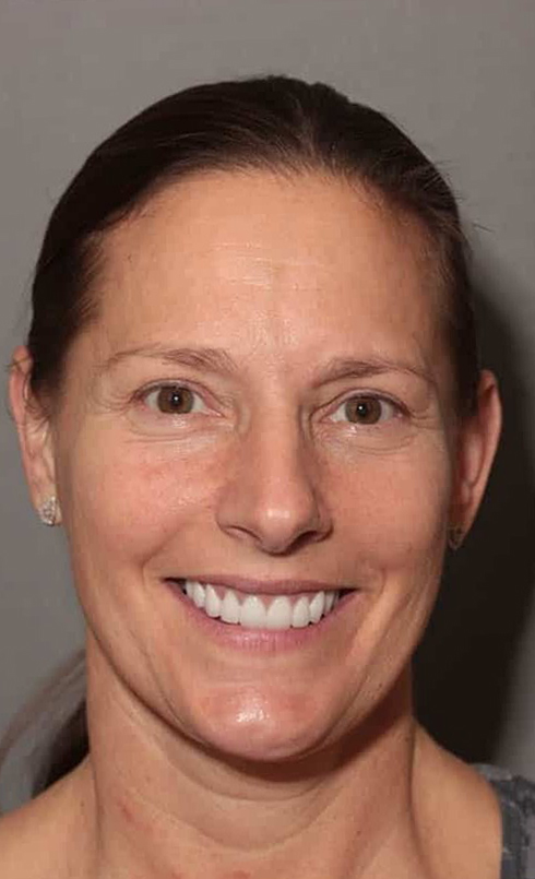 After Image: Porcelain Crowns - front