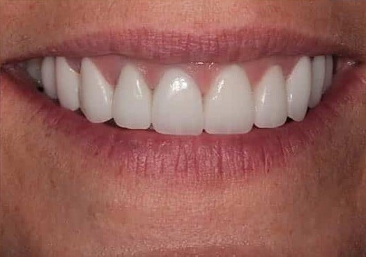 After Image: Porcelain Crowns - front