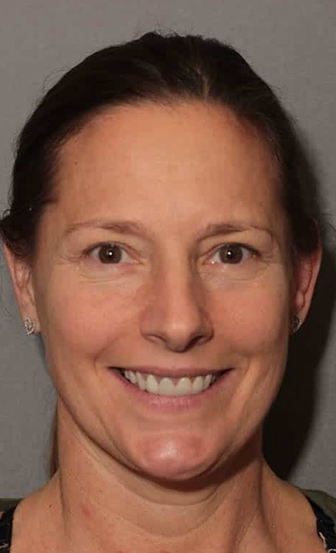 Before Image: Porcelain Crowns - front