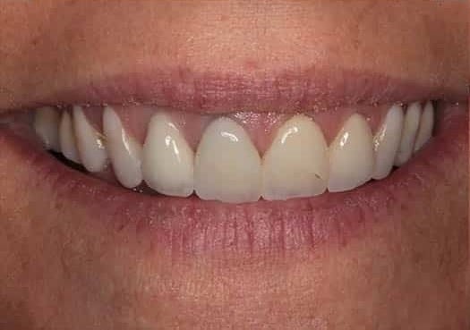 Before Image: Porcelain Crowns - front