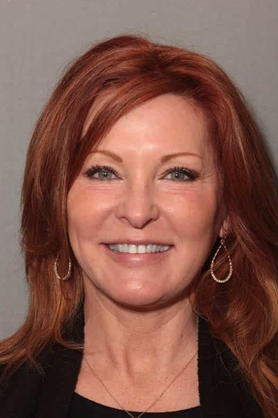 Before Image: Porcelain Crowns - front