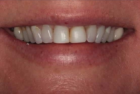 Before Image: Porcelain Crowns - front