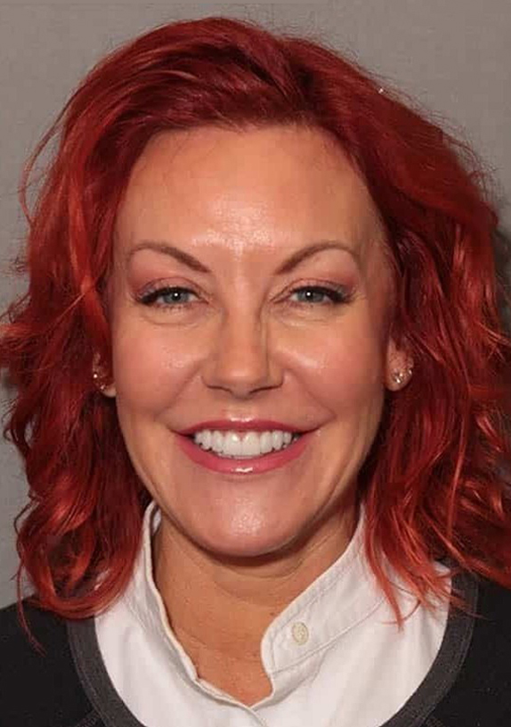 After Image: Porcelain Crowns - front