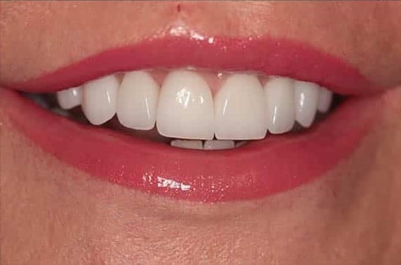 After Image: Porcelain Crowns - front
