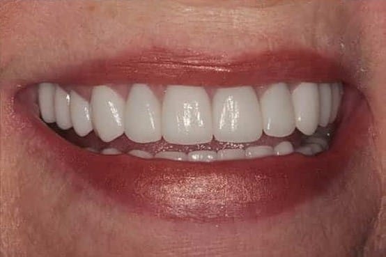 After Image: Porcelain Crowns - front