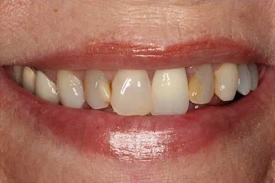 Before Image: Porcelain Crowns - front