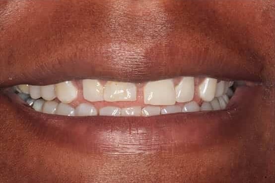 Before Image: Porcelain Veneers - front