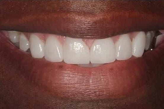 After Image: Porcelain Veneers - front