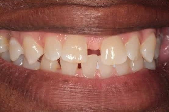 Before Image: Porcelain Veneers - front