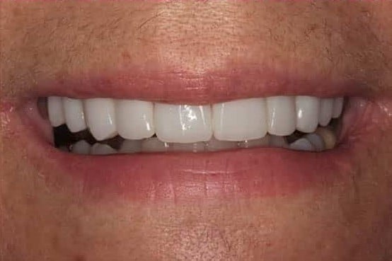 After Image: Porcelain Veneers - front