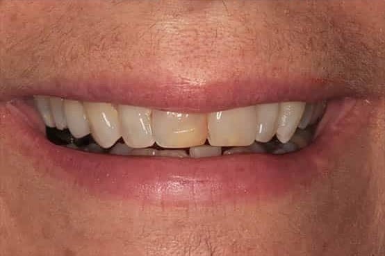 Before Image: Porcelain Veneers - front