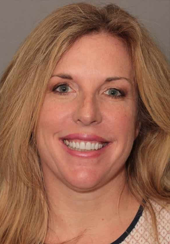 After Image: Porcelain Veneers - front